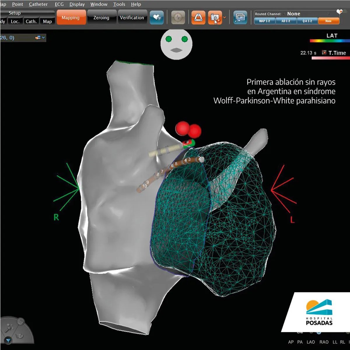 Primer procedimiento en Argentina de ablaci&oacute;n por radiofrecuencia card&iacute;aca sin utilizaci&oacute;n de Rayos X. Foto: Hospital Posadas.
