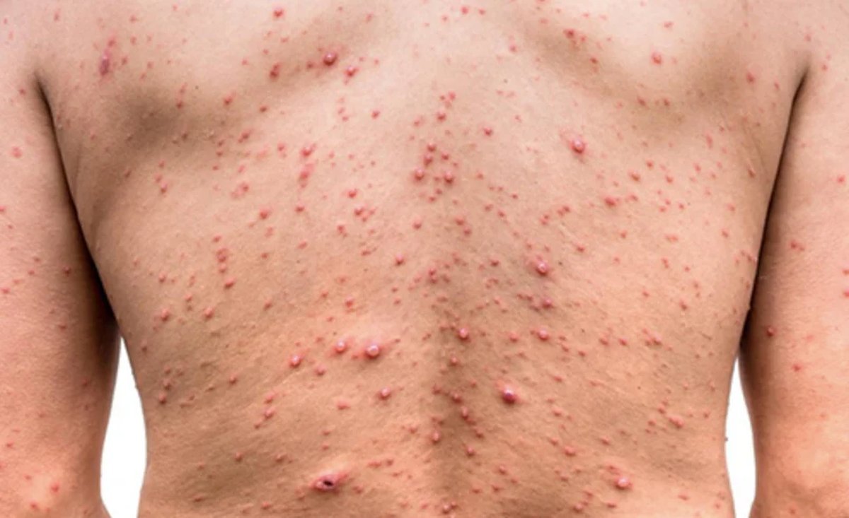 El paciente se encuentra en buen estado de salud, internado para su cuidado y cumpliendo el aislamiento correspondiente.