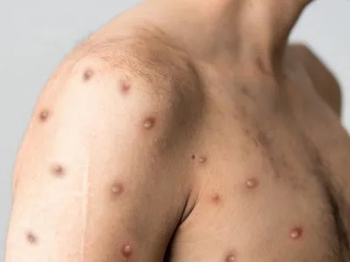 Viruela del Mono: c&oacute;mo se transmite y cu&aacute;les son los s&iacute;ntomas