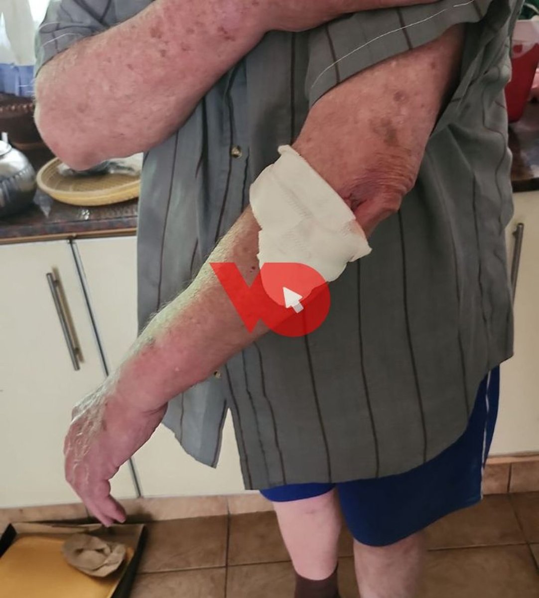 As&iacute; qued&oacute; el brazo del jubilado de Lomas del Mirador.